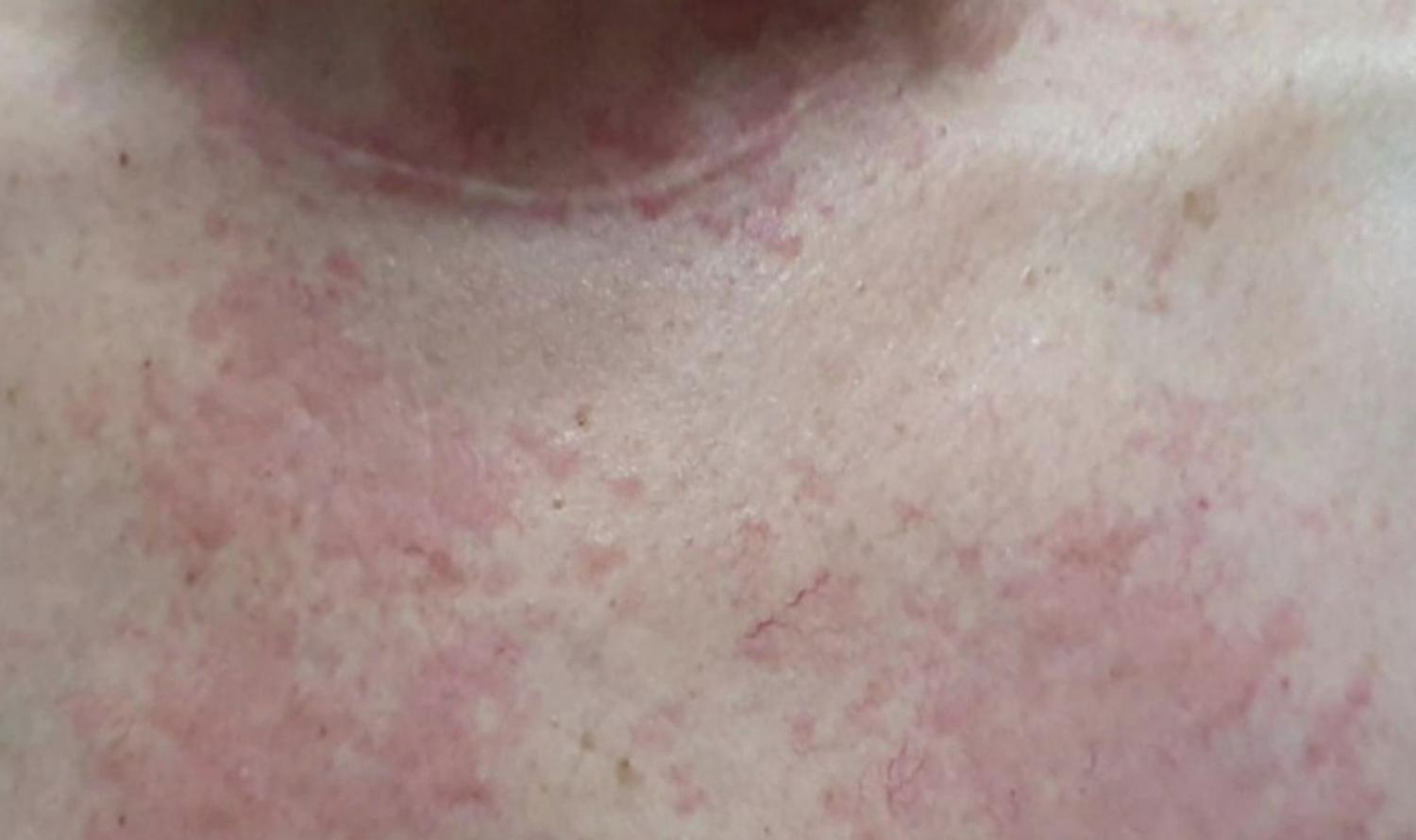 Casos de lesões que provocam coceira são notificados em Floresta, Serra Talhada e Triunfo