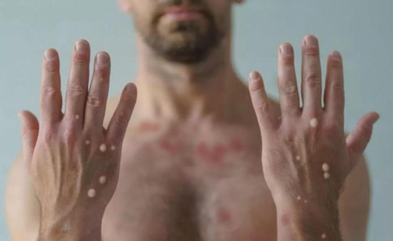 Pernambuco confirma mais dois casos de Varíola dos Macacos