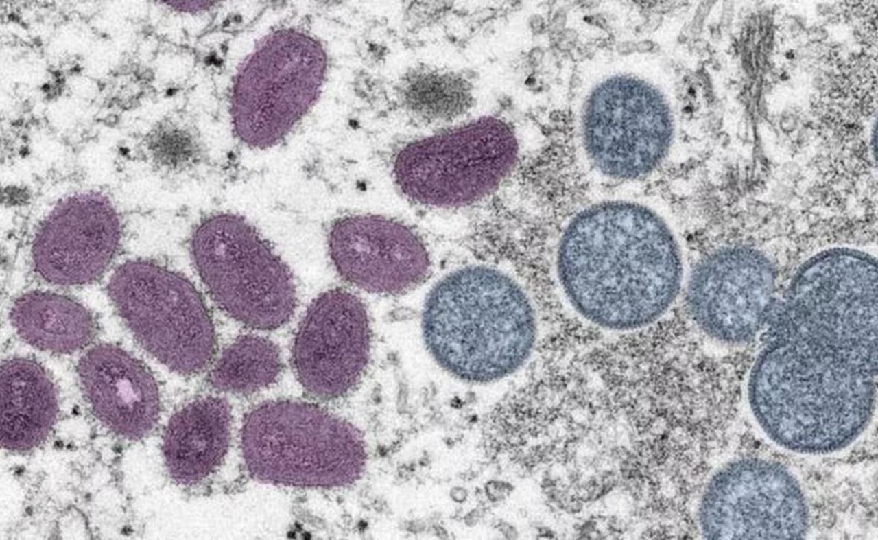 Sobe para 164 número de casos confirmados de varíola dos macacos em PE