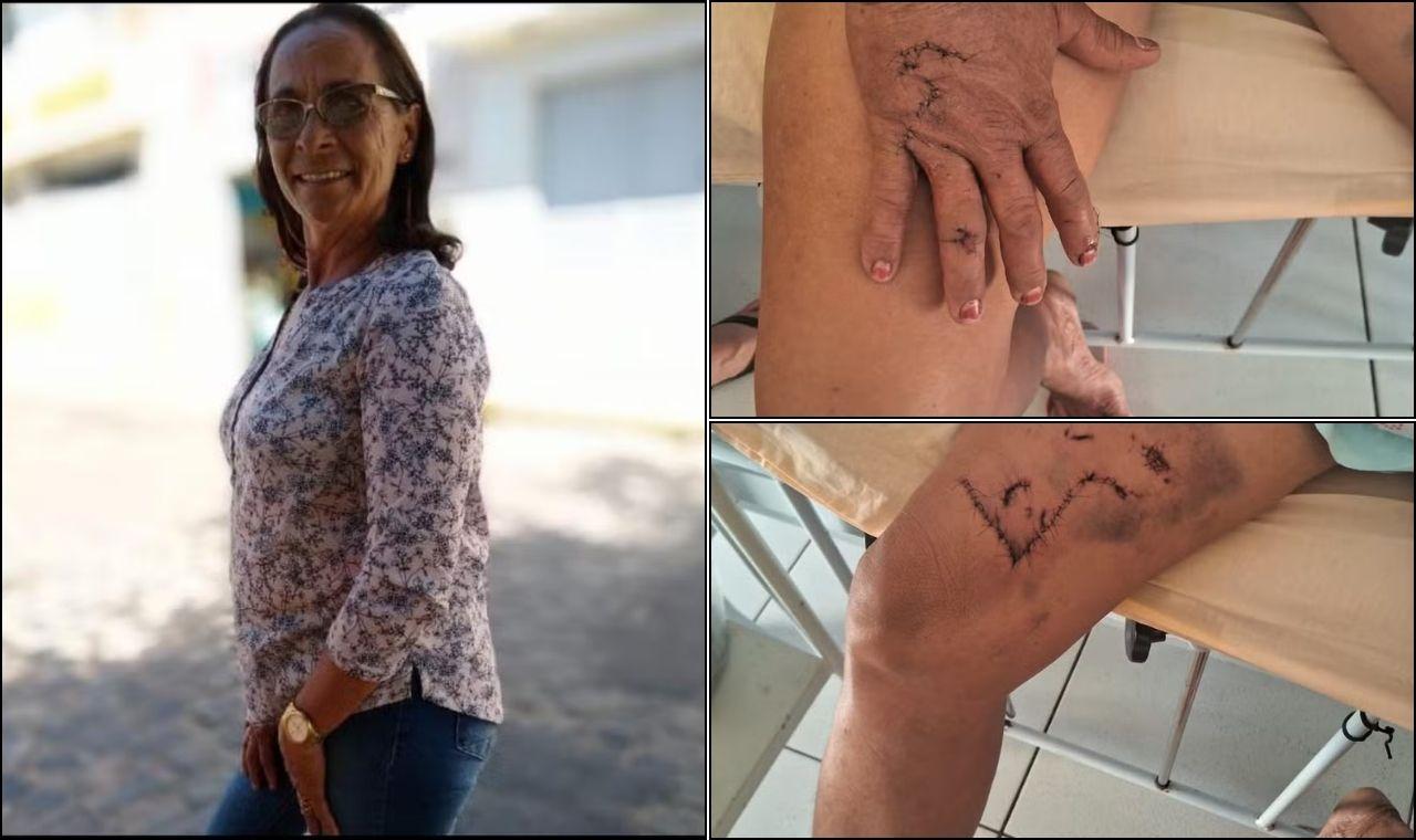 AGRICULTORA DE 58 ANOS É ATACADA POR ONÇA-PARDA EM CARNAUBEIRA DA PENHA, PE